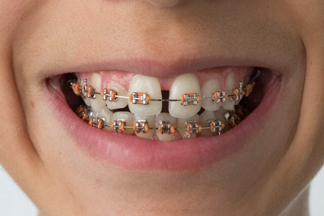 Common Issues With Braces At Home Fixes Salaita Orthodontics