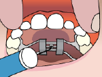 Illustration of placing the key in a palatal expander 